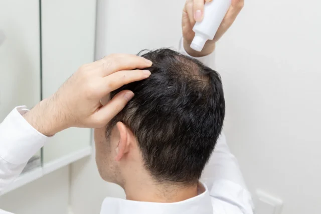 AGA市販薬のミノキシジル外用薬はどんな効果がある？