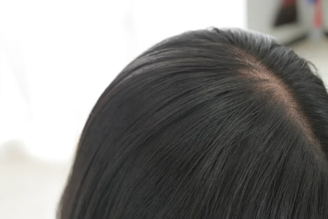 女性特有の薄毛（びまん性脱毛症・FAGA）の原因と特徴